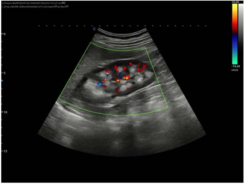 Ultrasound Diagnosis of Medullary Sponge Kidneys