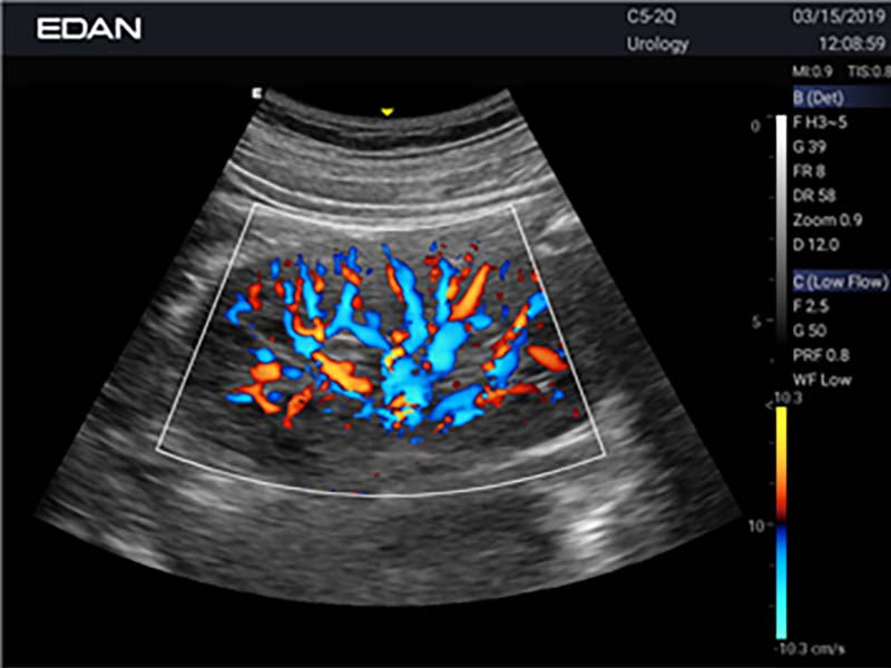 Edan Acclarix LX3 Cart-Based Color Doppler Ultrasound