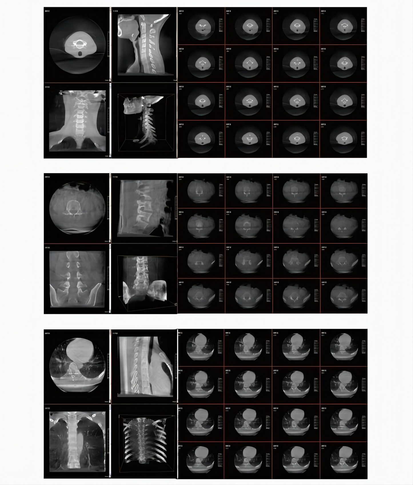 GHM-750 Digital Intraoperative 3D C-arm System